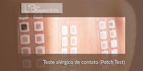 Teste alérgico de contato Patch Test