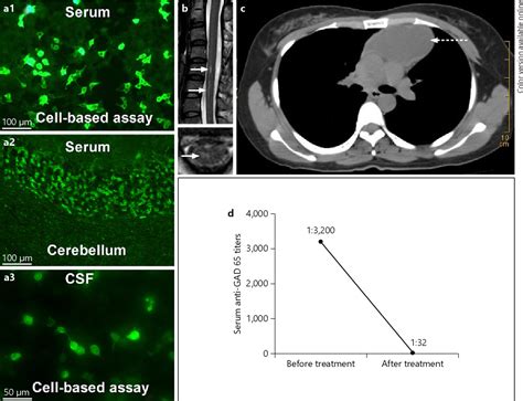 Figure 1 from Glutamic Acid Decarboxylase Antibody in a Patient with Myelitis: A Retrospective ...