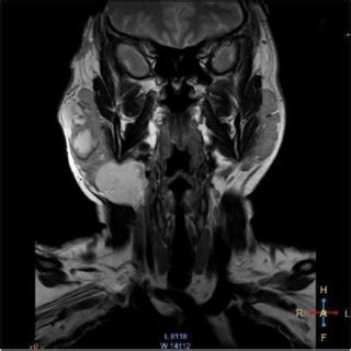 MRI scan showing enlarged parotid gland. | Download Scientific Diagram