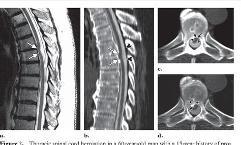 Imaging Of Idiopathic Spinal Cord Herniation Radiographics Hot Sex Picture