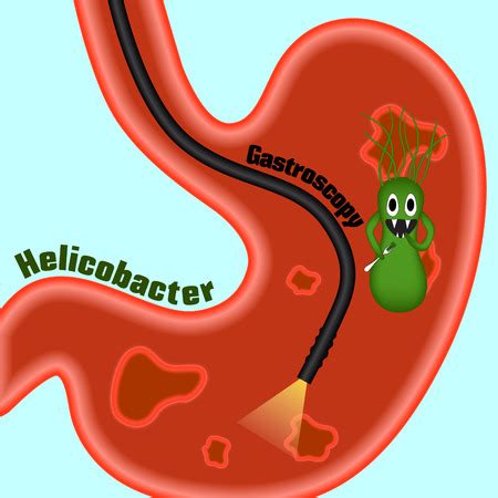 Vector of Gastroscopy, research of a - ID:56909665 - Royalty Free Image ...