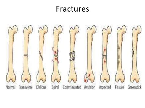 3 Main Types Of Fractures