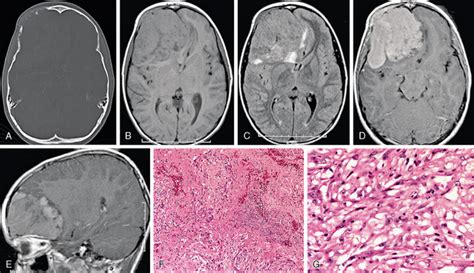 Meningeal Neoplasms Radiology Key