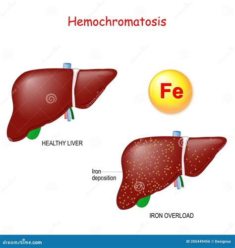 Hemochromatosis Or Iron Overload. Healthy Liver And Liver With Iron ...