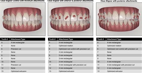 Invisalign Attachment Template