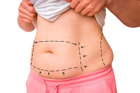 Diferencias Entre Una Abdominoplastia Convencional Y Una Mini