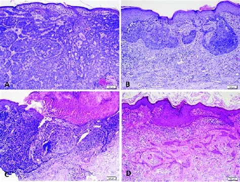 A Nodular Basal Cell Carcinoma The Tumour Forms Solid Tumour Nodules