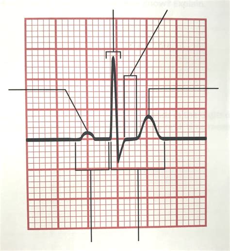 Standard Ecg Recording Diagram Quizlet