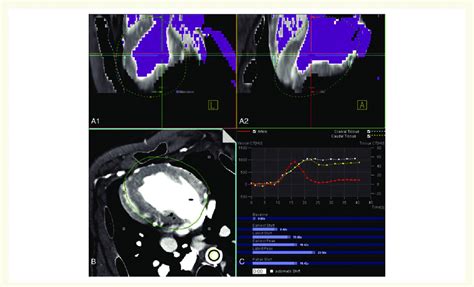 Ct Perfusion Imaging Post Processing A1 And A2 Show The