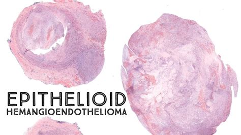 Epithelioid Hemangioendothelioma Ehe Australasian Dermpath