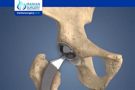 Partial Hip Replacement | Iranian Surgery