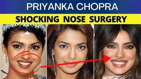 SHOCKING Priyanka Chopra NOSE PLASTIC SURGERY DETAILS In