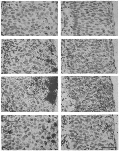 HPV 16 Transcription In A CIN 2 Lesion With Late Gene Expression