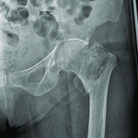 A 75-year-old patient with osteoporosis. Post fallen radiography shows... | Download Scientific ...