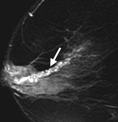 Ductal Carcinoma In Situ Of The Breast Mr Imaging Findings With