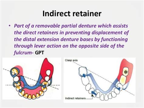 Designing A Removable Partial Denture Kennedys Classification