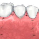 Regenerative Surgery Gta North Periodontics Endodontics