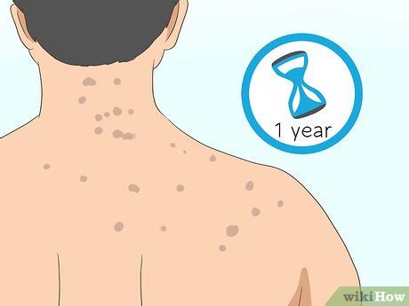 3 Ways to Get Rid of Back Acne Scars - wikiHow