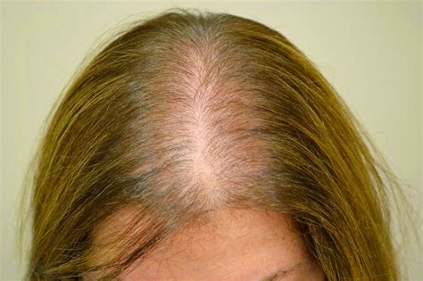 Alopecia Androgenetica Behandeling Willeke Kamphof