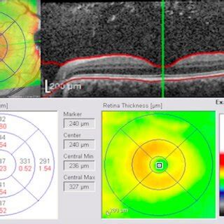 The overall macular OCT. The image of the macular region was acquired... | Download Scientific ...