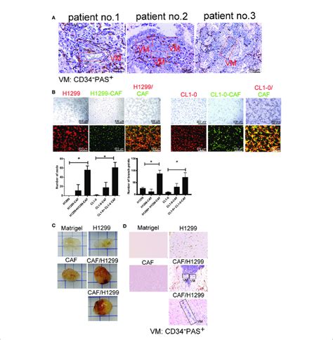 Cancer Associated Fibroblasts Cafs Promote Vascular Mimicry Vm In