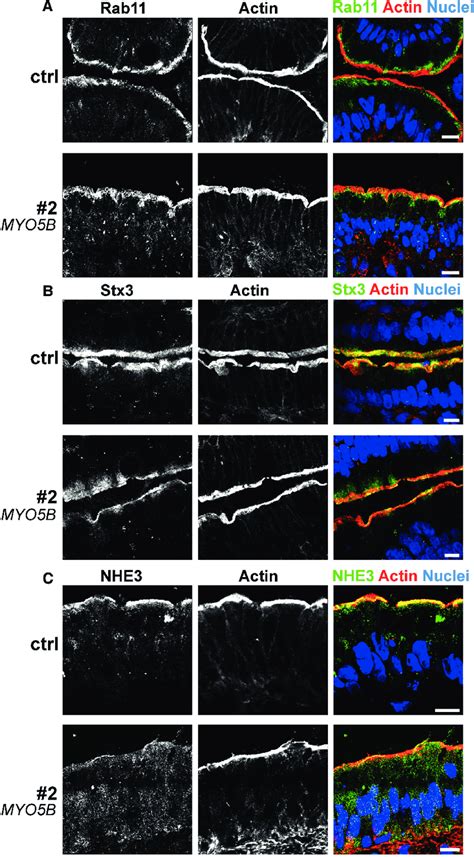 Immuno Fluorescence Microscopy Of Duodenum Biopsies From Patient No