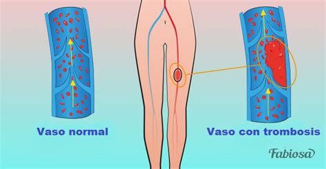 Te Enseñamos A Identificar La Trombosis Y Cómo Tratarla Via Ritmo