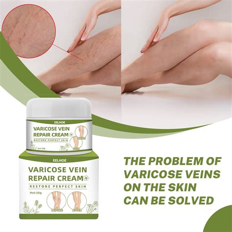 Varicose Vein Cream Ointment Leg Swelling Care Cream 50g Shopee Philippines