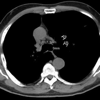 Chest CT scan demonstrating two new left lung nodules | Download Scientific Diagram