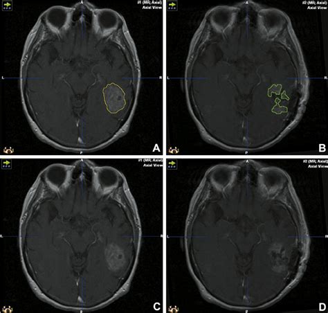 Axial Slices From T1 Weighted Postcontrast Magnetic Resonance Imaging