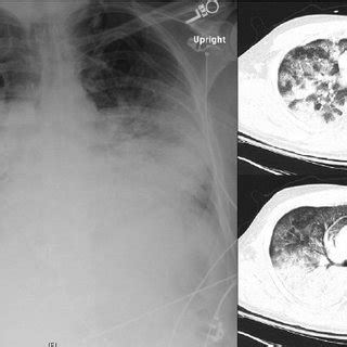 Chest X Ray And Computed Tomography Images Demonstrating Bilateral