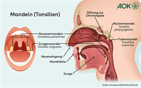 Was hilft gegen Mandelentzündung