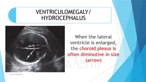 Hydrocephalus Ultrasound