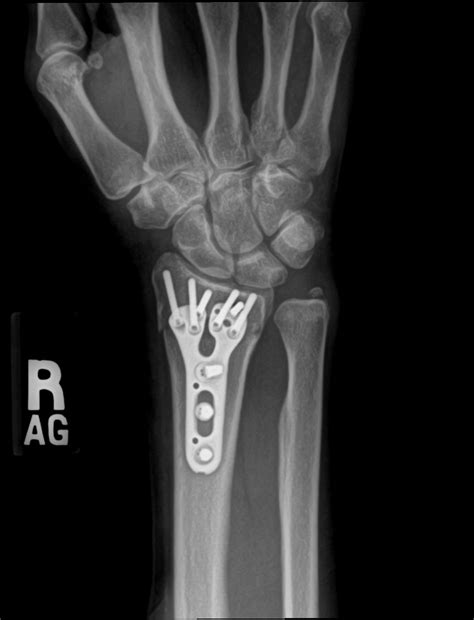 Broken Wrist Treatment in Raleigh, NC - John Erickson, MD