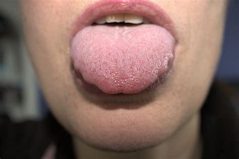 Tingling Tongue Causes And When To See A Doctor 52 Off