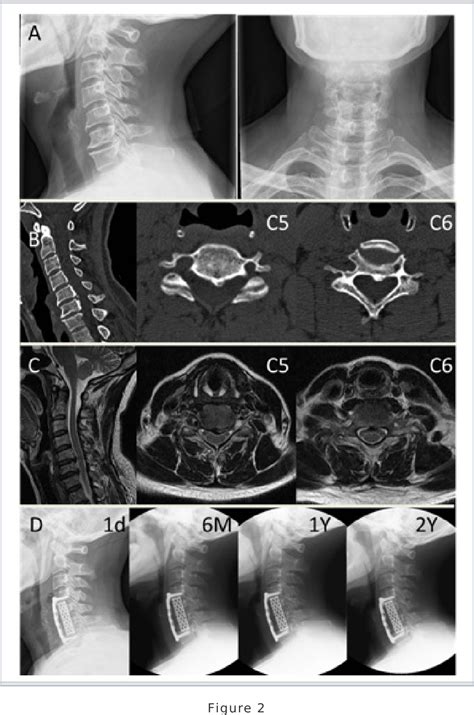 Figure 1 From Multilevel Anterior Cervical Corpectomy And Fusion For