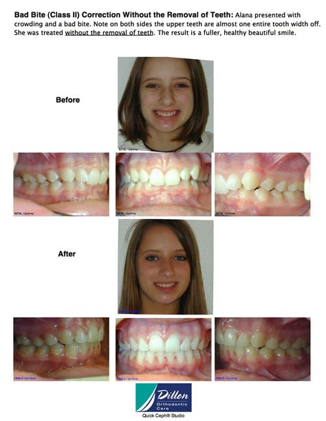 Gallery Invisalign Near Me Dillon Orthodontic Care