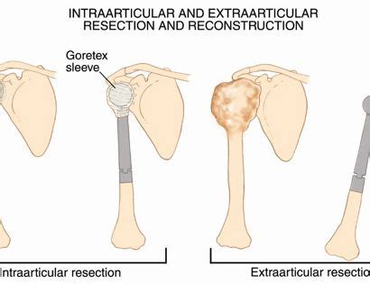 Proximal Humerus Prosthetic Replacement