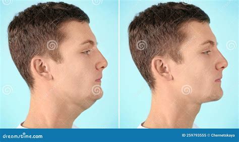 Double Chin Problem Collage With Photos Of Man Before And After