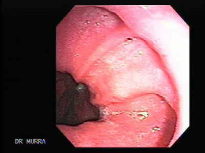 Barret S Esophagus The Gastrointestinalatlas Gastrointestinalatlas