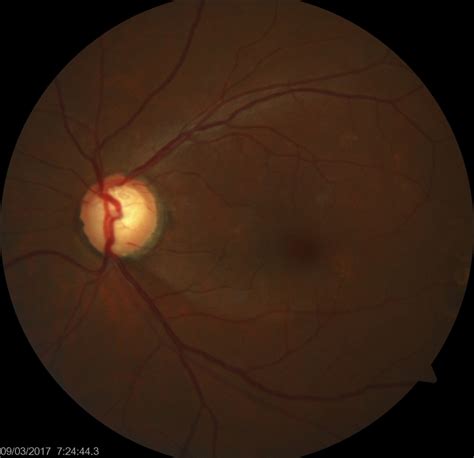 Figure Glaucomatous Optic Nerve Head Showing StatPearls NCBI