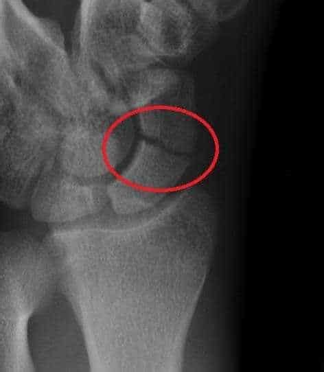 Articulaci N Radiocarpiana