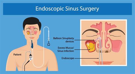 Endoscopic Sinus Surgery Philadelphia Bergerhenry Ent