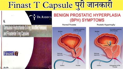 Finast T Capsule Tamsulosin And Finasteride Capsule Uses Dose