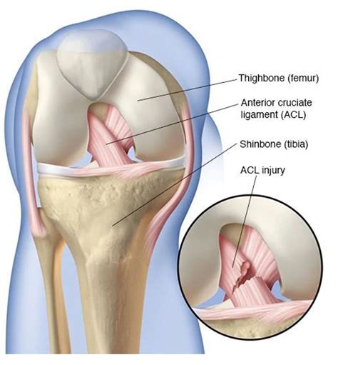 The Anterior Cruciate Ligament Acl