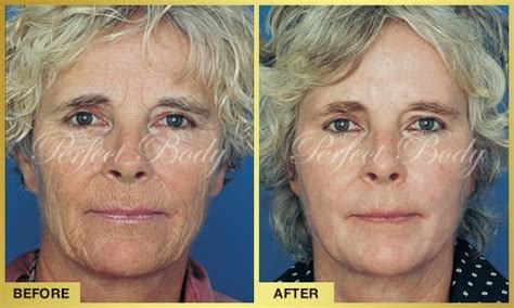 Face Neck Jawline Lift Gallery Perfect Body Laser And Aesthetics