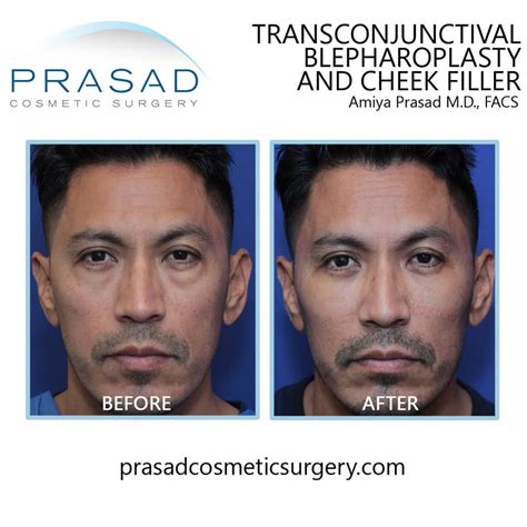 Effective Treatment Options for Bags Under the Eyes | Dr. Prasad Blog