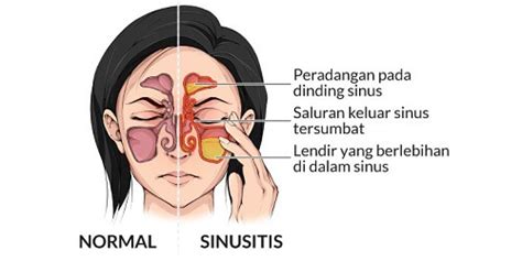 Cara Dokter Penang Mengobati Sinusitis