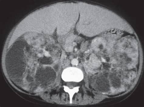 Scielo Brasil Imaging Of Tuberous Sclerosis Complex A Pictorial