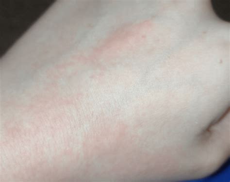 Red rashes(?) and raised bumps when I scratch or rub my skin : r ...